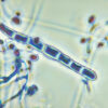 Two cases of ringworm detected in New York