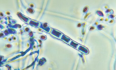 Two cases of ringworm detected in New York