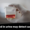 Blood in Urine Routine might be dangerous