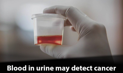 Blood in Urine Routine might be dangerous