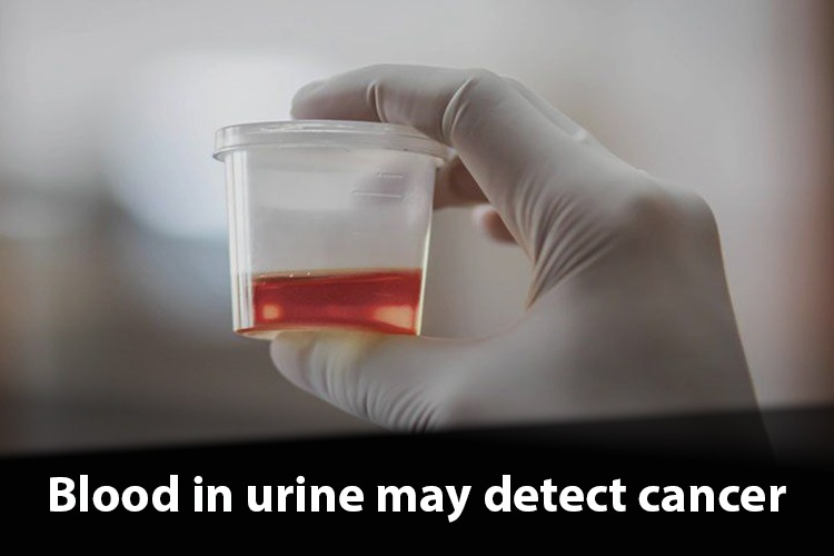 Blood in Urine Routine might be dangerous