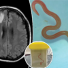 All about the world's first case of live parasitic worm