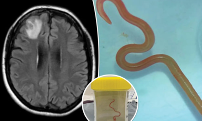 All about the world's first case of live parasitic worm