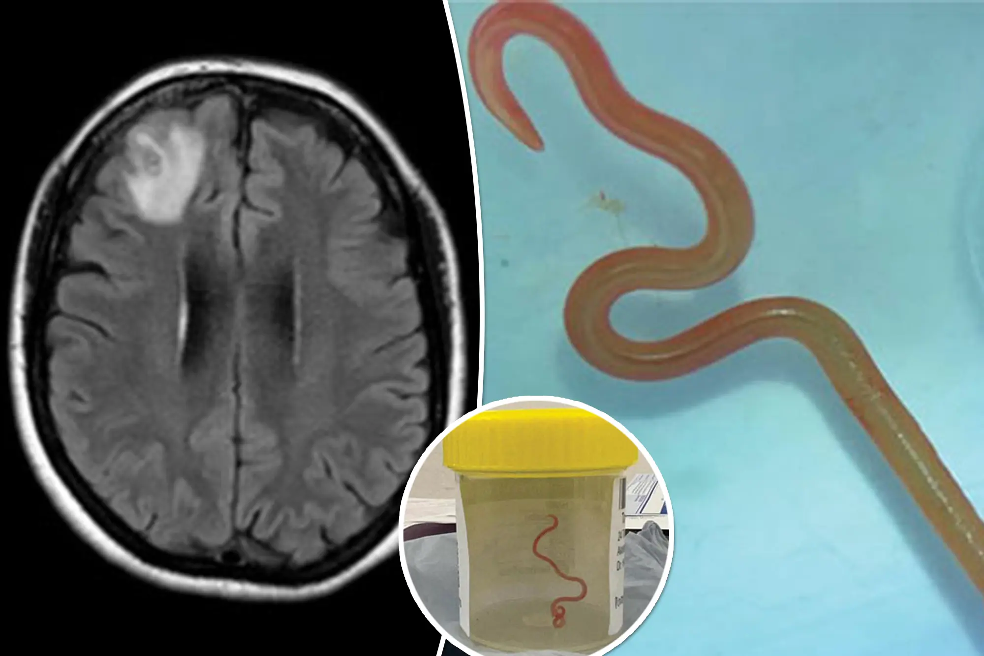 All about the world's first case of live parasitic worm