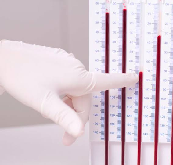 The ESR test, or ESR blood test, measures inflammation by measuring how quickly red blood cells settle in a tube.