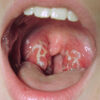 Strep throat is a bacterial infection that targets the throat and tonsils, caused by group A Streptococcus, or Streptococcus pyogenes.