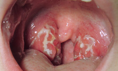 Strep throat is a bacterial infection that targets the throat and tonsils, caused by group A Streptococcus, or Streptococcus pyogenes.