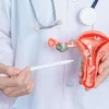 Polycystic Ovary Syndrome (PCOS) is a common hormonal disorder that affects women of reproductive age.