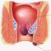 Hemorrhoids, commonly referred to as piles, are a common condition that can cause discomfort, pain, and itching.