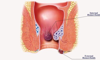 Hemorrhoids, commonly referred to as piles, are a common condition that can cause discomfort, pain, and itching.