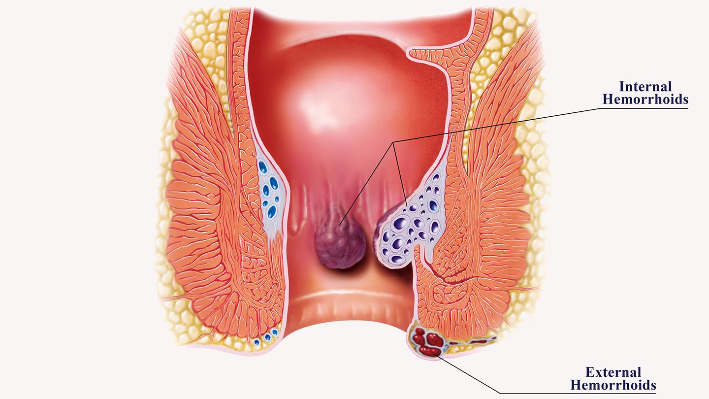 Hemorrhoids, commonly referred to as piles, are a common condition that can cause discomfort, pain, and itching.